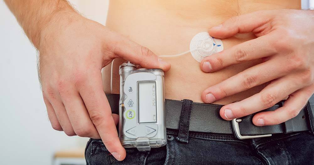 Closed Loop Insulin Pumps