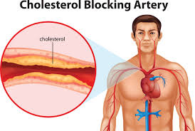 How Cholesterol Affects Blood Sugar Control in Type 2 Diabetes