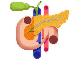 How Pancreatitis Leads to Type 2 Diabetes