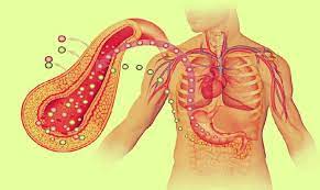 How Insulin Dysregulation Leads to Type 2 Diabetes