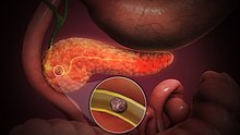 How Abdominal Trauma Leads to Pancreatic Damage and Diabetes