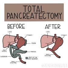 How Partial Pancreatectomy Triggers Type 3c Diabetes