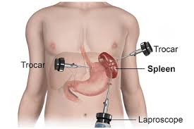 How Abdominal Trauma Leads to Pancreatic Damage and Diabetes