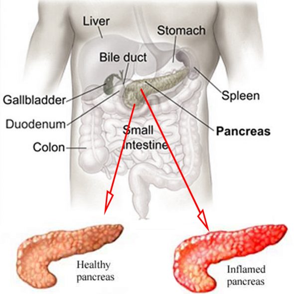 How Necrosis Affects Pancreatic Tissue in Type 3c Diabetes