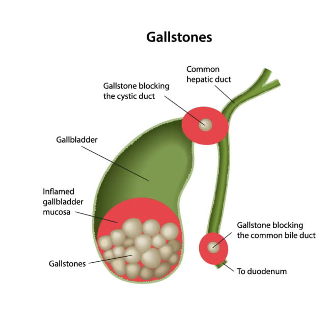 How Gallstones Trigger Pancreatic Inflammation in Type 3c Diabetes