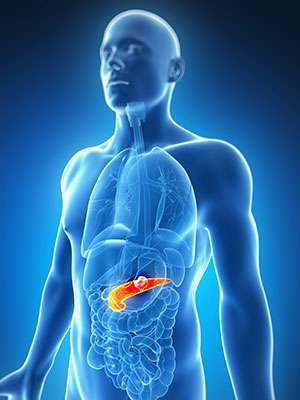 How Pancreatic Cancer Contributes to Type 3c Diabetes