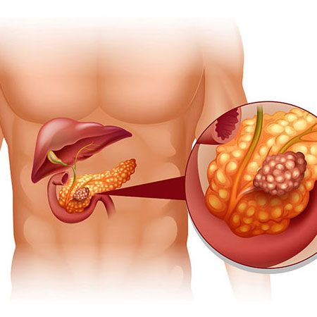 How Pancreatic Enzyme Insufficiency Affects Digestion in Type 3c Diabetes