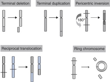 How Chromosomal Abnormalities Trigger Neonatal Diabetes