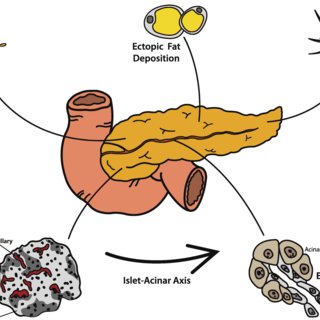 How Underdeveloped Pancreas Leads to Neonatal Diabetes