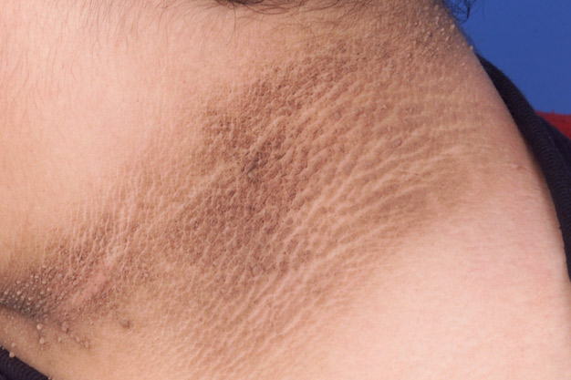 Understanding Acanthosis Nigricans and Its Link to Alström Syndrome