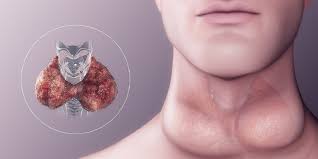 How Hypothyroidism Develops in Alström Syndrome Patients