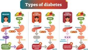 What Is the Difference Between LADA Type 1 and Type 2 Diabetes