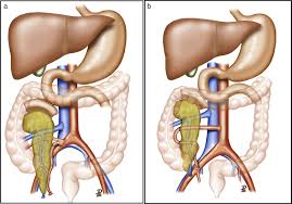 how pancreas transplant is an ideal solution to control type 1 and type 2 diabetes