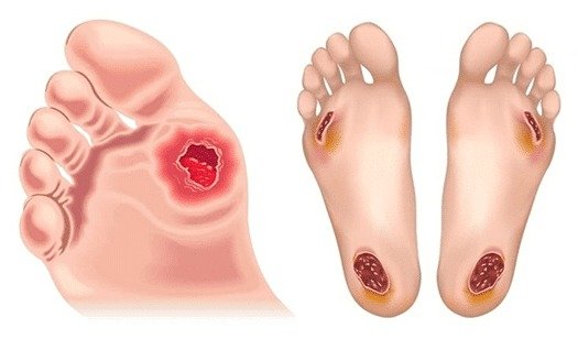 The Role of Bacterial and Fungal Infections in Type 1 Diabetes
