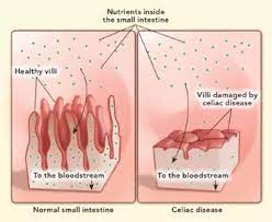 How Gluten Affects Glycemic Control in People with type 1 diabetes