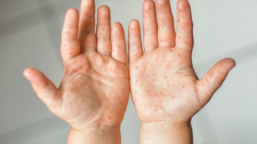 The Link Between Coxsackievirus and Diabetes