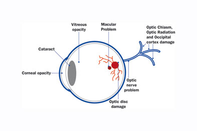 How to Recognize Retinal Dystrophy Symptoms at an Early Stage