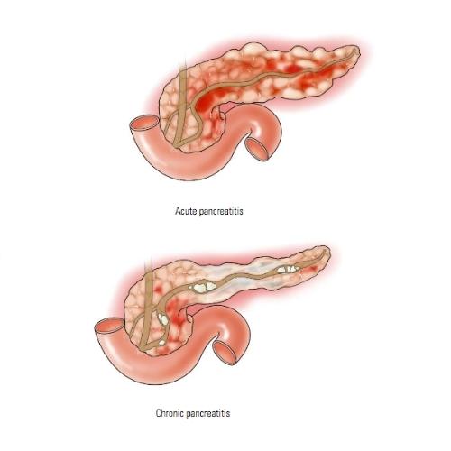 How Does Pancreatitis Lead to Type 3c Diabetes