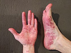 How Coxsackievirus Might Trigger Type 1 Diabetes