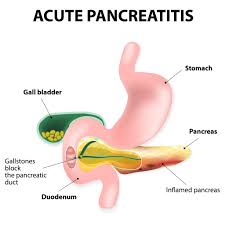 How Pancreatitis Damages the Pancreas