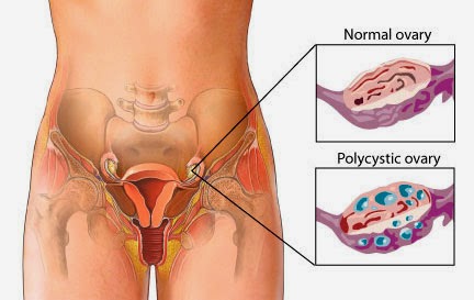 Strategies to Manage Insulin Resistance in PCOS