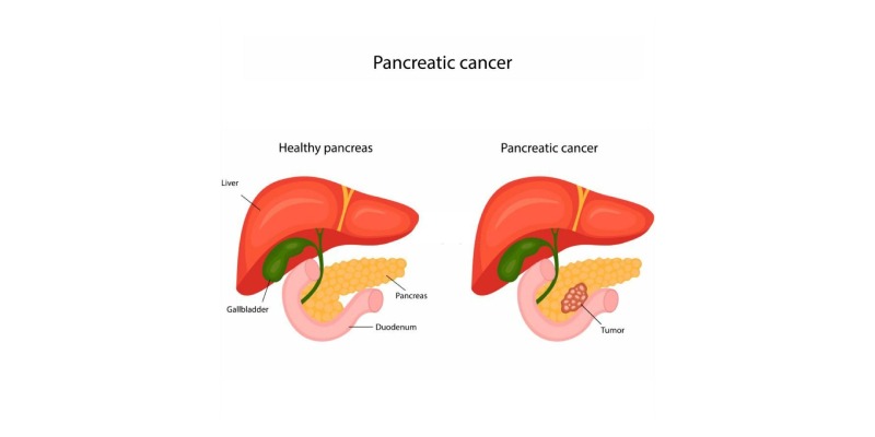 FAQs on Pancreatic Cancer and Type 3c Diabetes