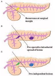 FAQs on Pancreatic Tumor & Insulin Production