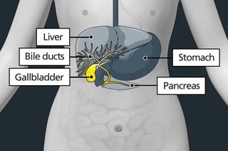 how gallstones cause inflammation in type 3c diabetes