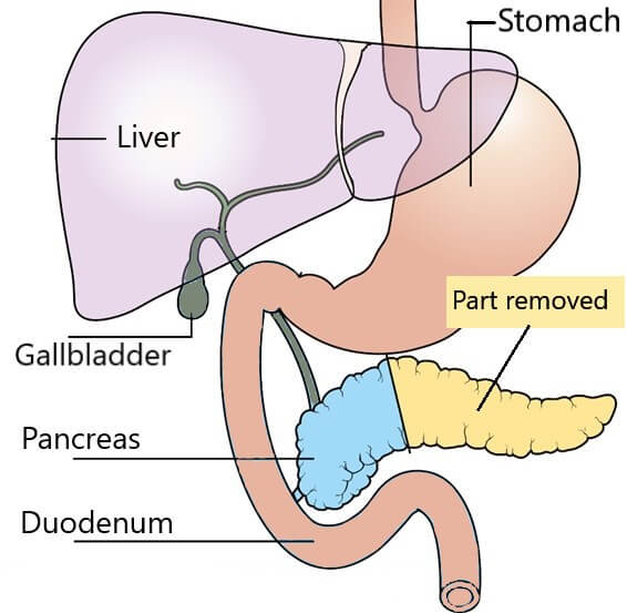 Why Partial Pancreatectomy and Splenectomy Complicate Matters