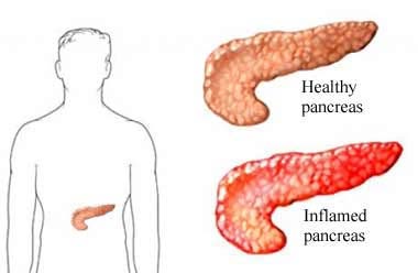 FAQs on Chronic Inflammation & Type 3c Diabetes