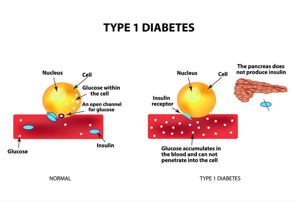 Role of HLA-DR3 and HLA-DR4 in Type 1 Diabetes Development